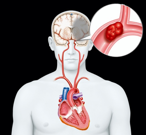 心臓にできた血栓が脳内に流れ頭蓋内血管を閉塞