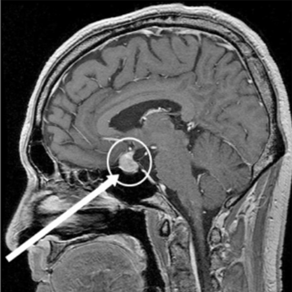 下垂体腺腫のMRI写真